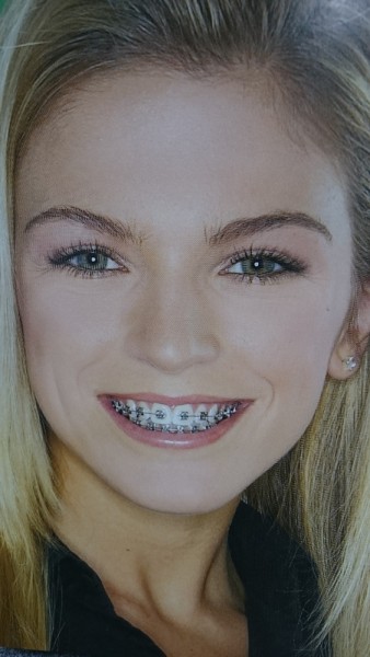 blondynka-z-aparatem-ortodontycznym